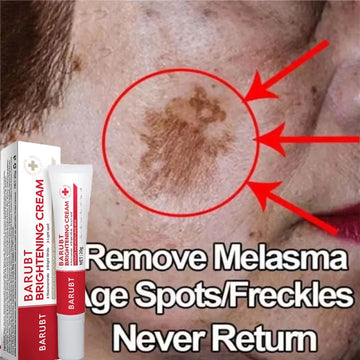 Powerful Spot-removing Whitening Cream Brighten Skin Fast Eliminates Melanin Pigmentation Melasma Dark Spots Korean Skin